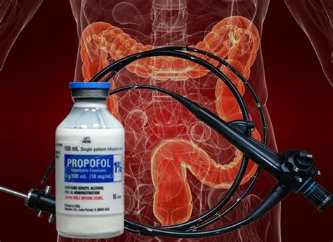 Strict aseptic technique must be used when drawing up <b>propofol</b>. . Propofol anesthesia for colonoscopy
